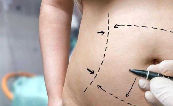 Зачем хирург рисует линии на теле перед операцией. Разметка в пластической хирургии